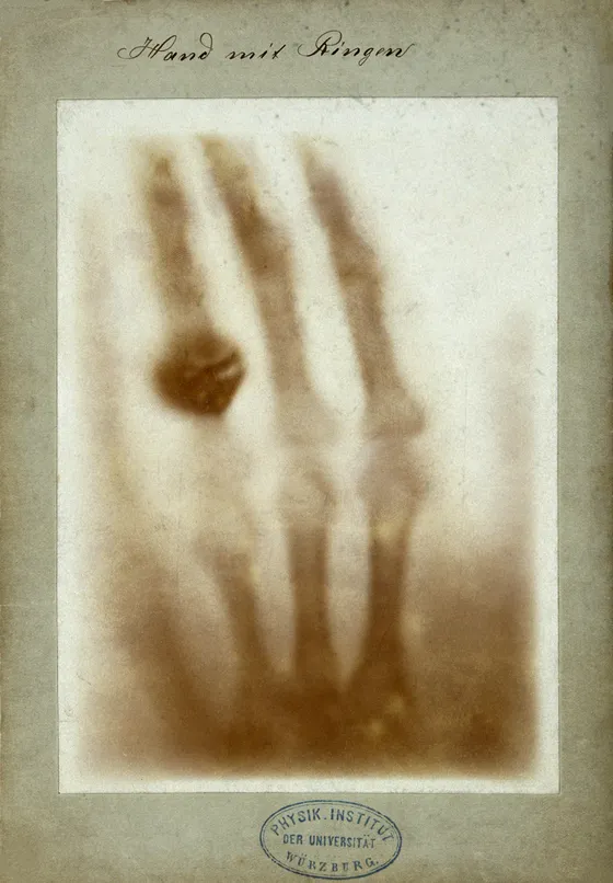 Hand mit Ringen: Röntgen’s 1895 X-ray print of a hand wearing a ring, mounted on a card stamped by the Physics Institute of the University of Würzburg
