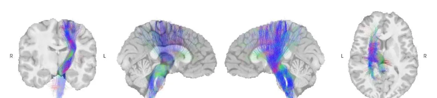 One white-matter bundle overlaid on brain MRI slices in four views: coronal, two sagittal and axial