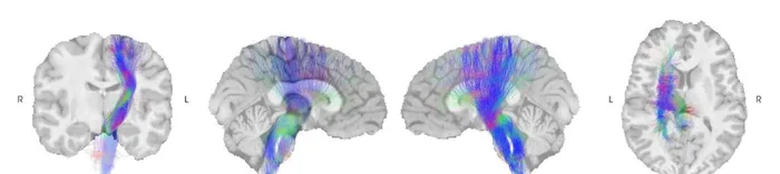 One white-matter bundle overlaid on brain MRI slices in four views: coronal, two sagittal and axial