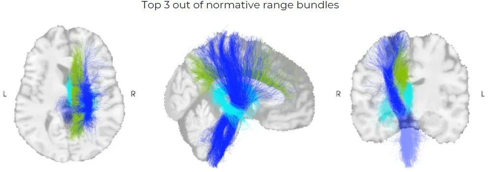 The top three out-of-range white matter bundles, shown in axial, sagittal and coronal views
