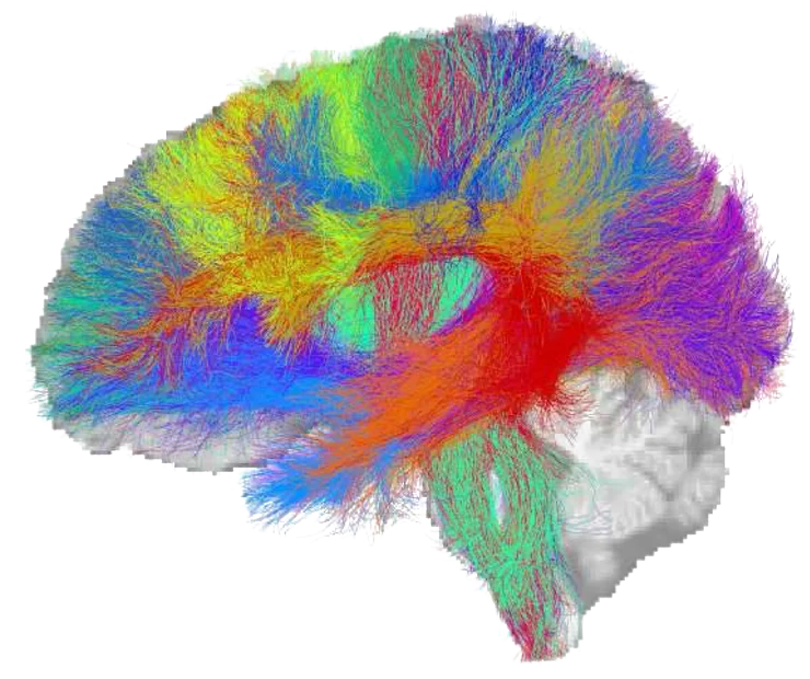 A whole-brain tractogram, side view, with white-matter fibers colored by bundle. Anonymized sample, IMEKA/ANDI.