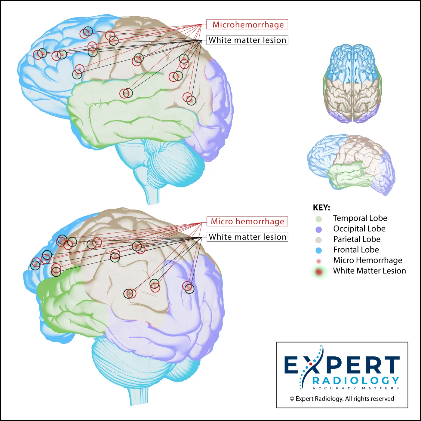 Brain pathology illustration with layered anatomy and finding context