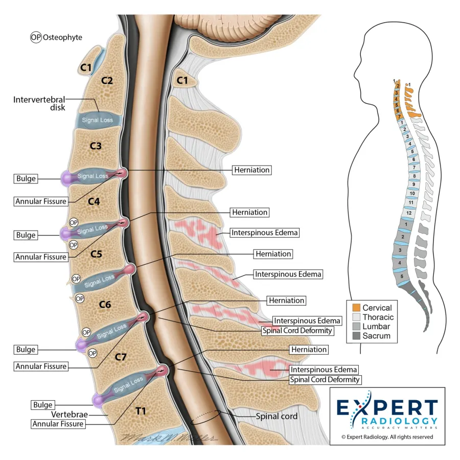Cervical spine illustration sample