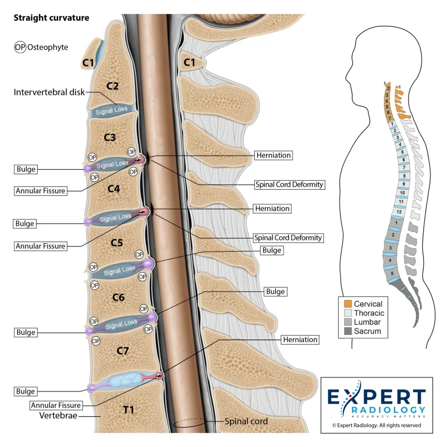 Cervical spine sagittal illustration with straightened alignment and multilevel pathology