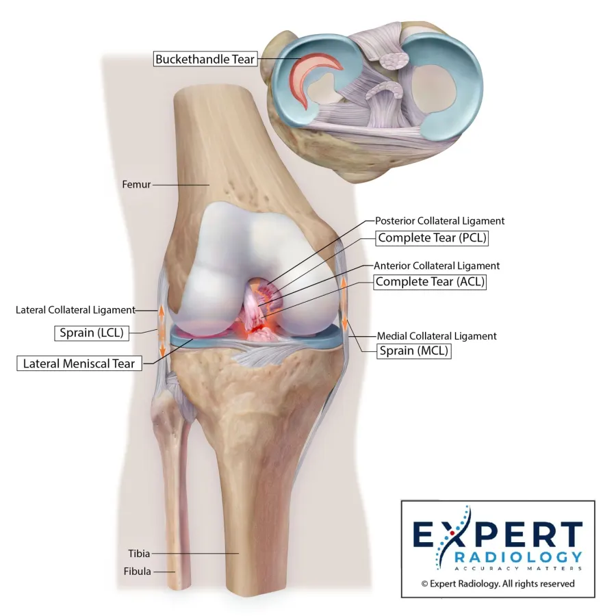 Knee ligament and meniscus medical illustration