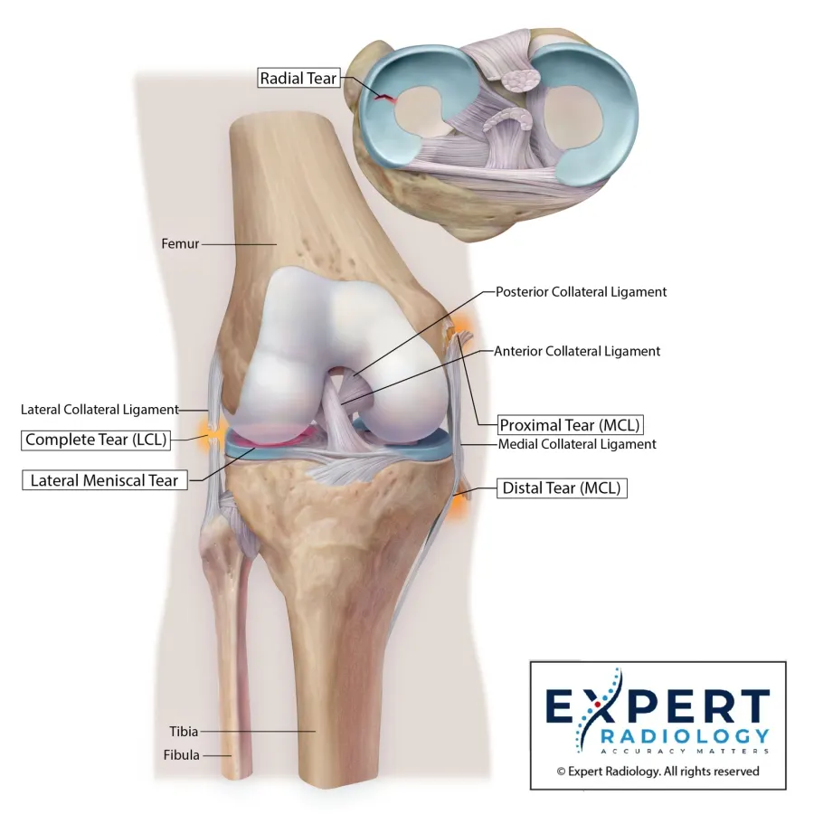 Knee deep-view illustration with multiligament injury pattern and meniscal involvement