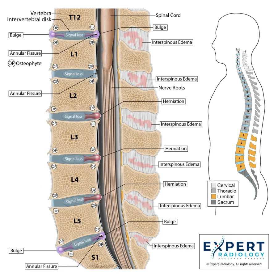 Lumbar spine sagittal illustration with straightened alignment and multilevel findings