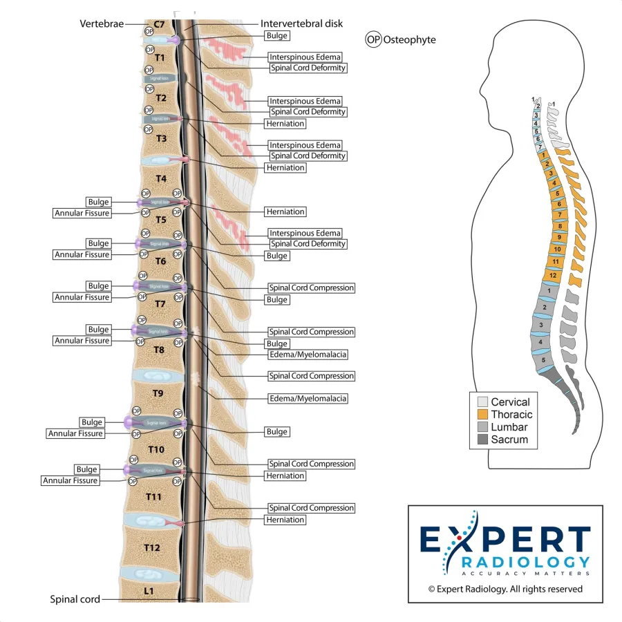 Thoracic spine sagittal illustration — straightened alignment with labeled disc pathology