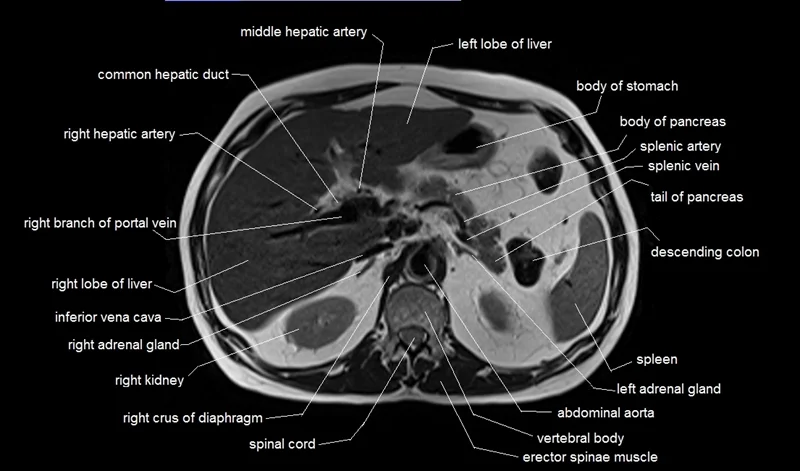 Labeled axial abdominal MRI showing solid organ anatomy