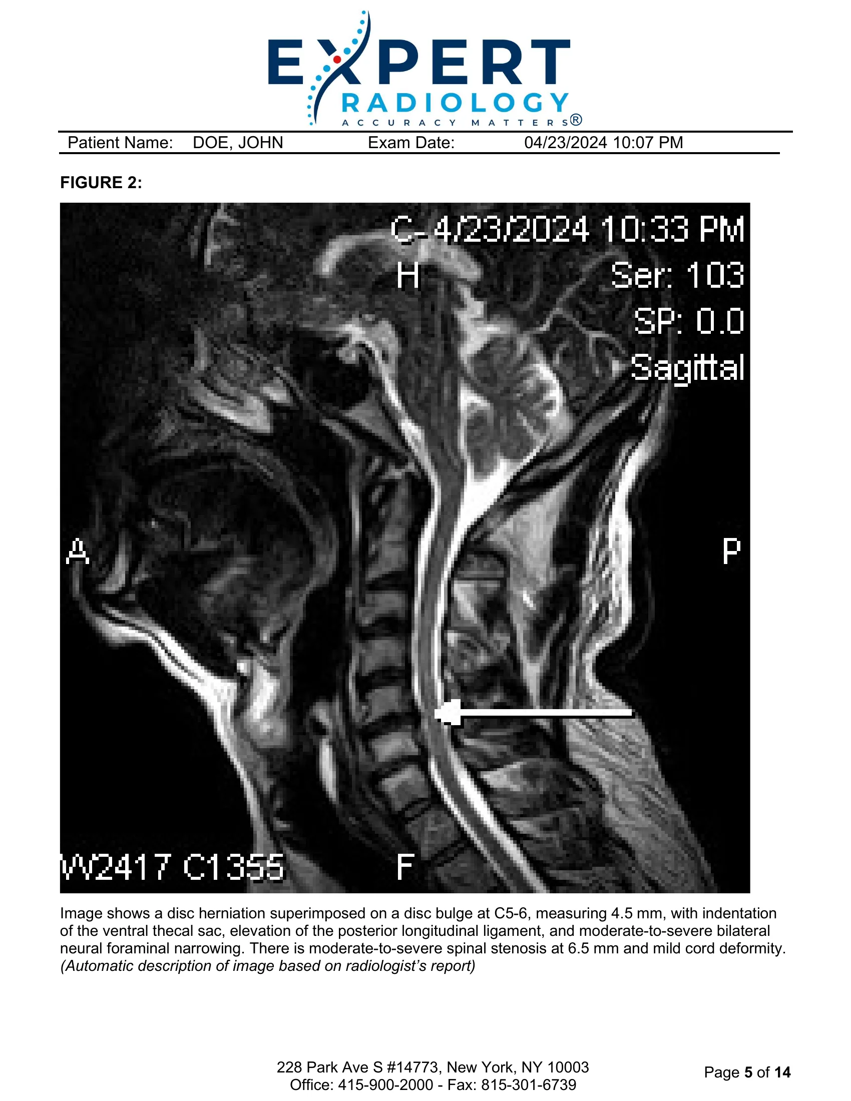 Page 5: Figure 2 MRI sagittal view, C5-6 disc herniation with annotation