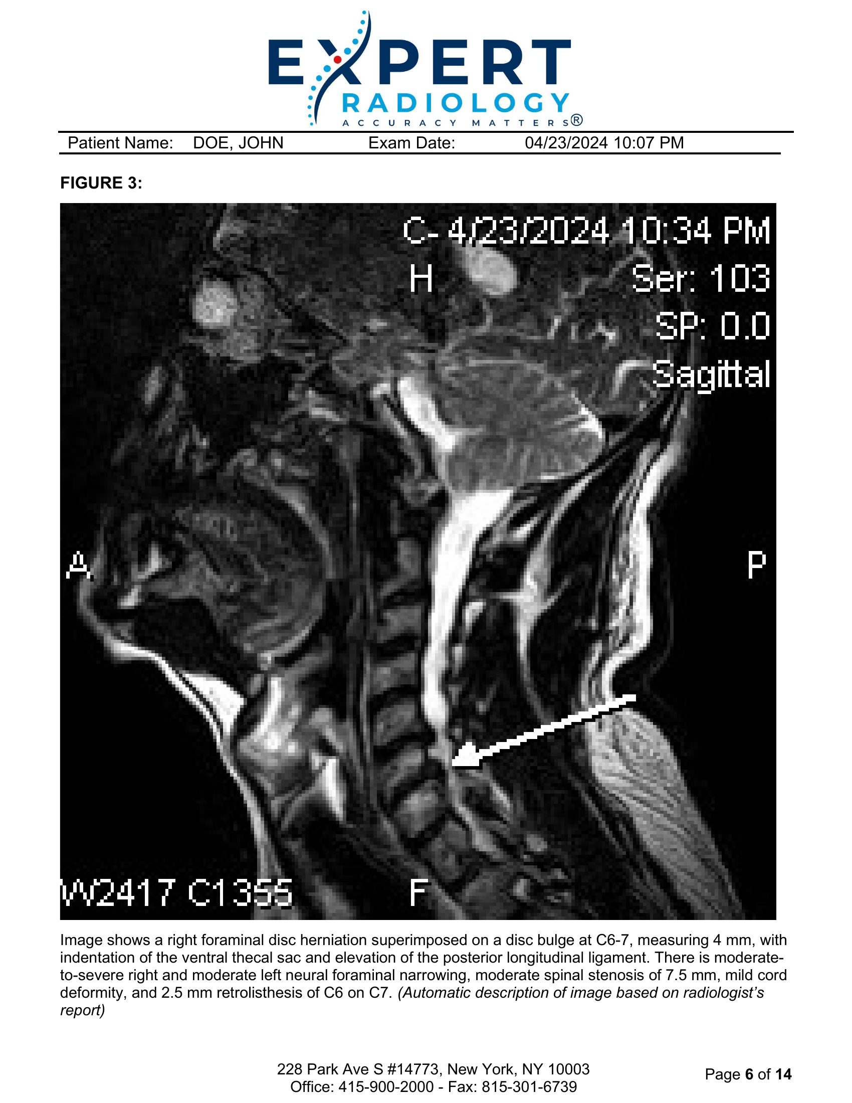 Page 6: Figure 3 MRI sagittal view, C6-7 right foraminal herniation with annotation
