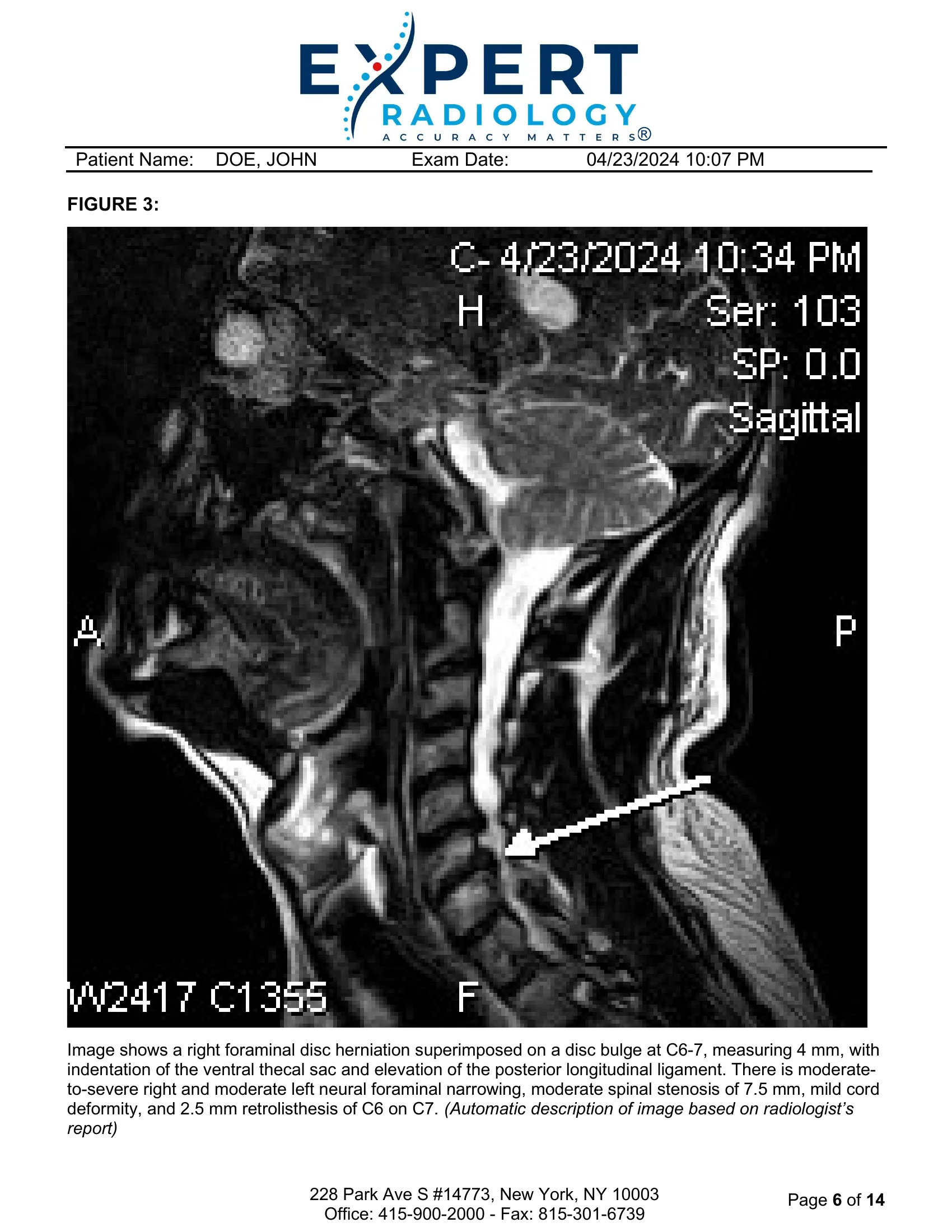 Page 6: Figure 3 MRI sagittal view, C6-7 right foraminal herniation with annotation