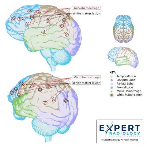 Expert Radiology illustration of the brain with color-coded lobes and marked microhemorrhages and white matter lesions