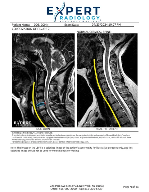 PrecisionPlus v3™ second opinion report page comparing a colorized sagittal MRI with a normal cervical spine