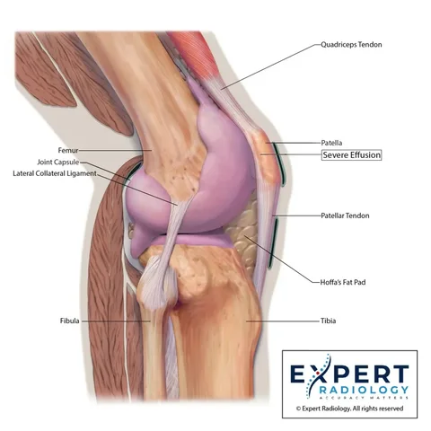 Expert Radiology illustration of the knee in lateral view with a joint effusion, the lateral collateral ligament, and the patellar tendon labeled