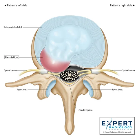 Expert Radiology illustration of a lumbar spine axial slice