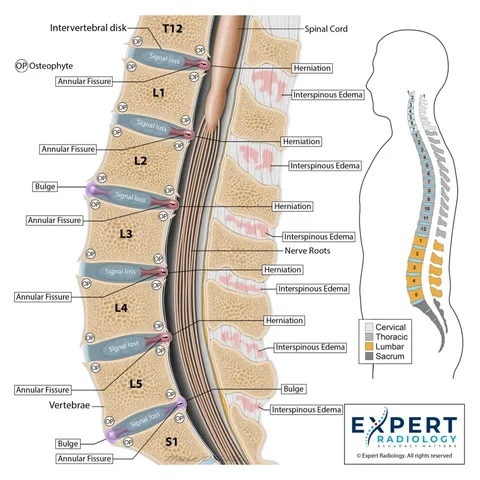 Expert Radiology illustration of the lumbar spine in sagittal view with labeled disc findings