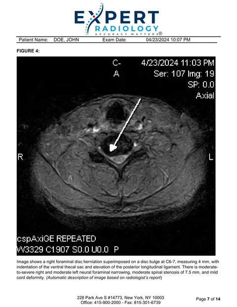 PrecisionPlus v3™ second opinion report page with Figure 4, an axial cervical MRI at C6-7 with an annotation arrow
