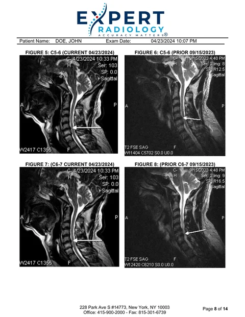 PrecisionPlus v3™ second opinion report page comparing current and prior sagittal cervical MRIs at C5-6 and C6-7