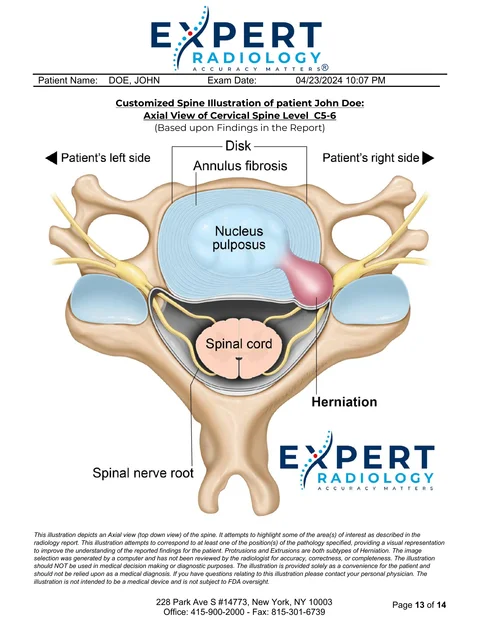 PrecisionPlus v3™ second opinion report page with the customized axial illustration of the cervical spine at C5-6 showing a disc herniation
