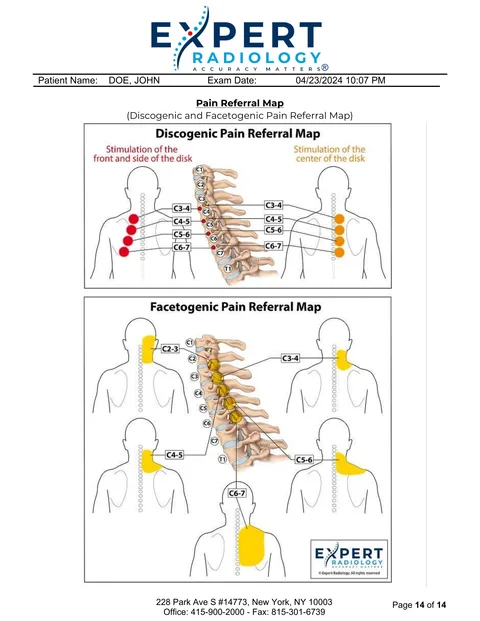 PrecisionPlus v3™ second opinion report page with discogenic and facetogenic pain referral maps