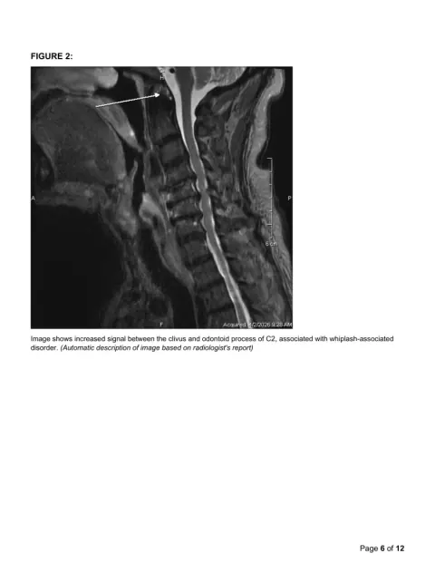 PrecisionPlus v3™ report page with Figure 2, a sagittal cervical MRI with an annotation arrow