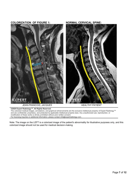 PrecisionPlus v3 report page with colorized cervical spine comparison