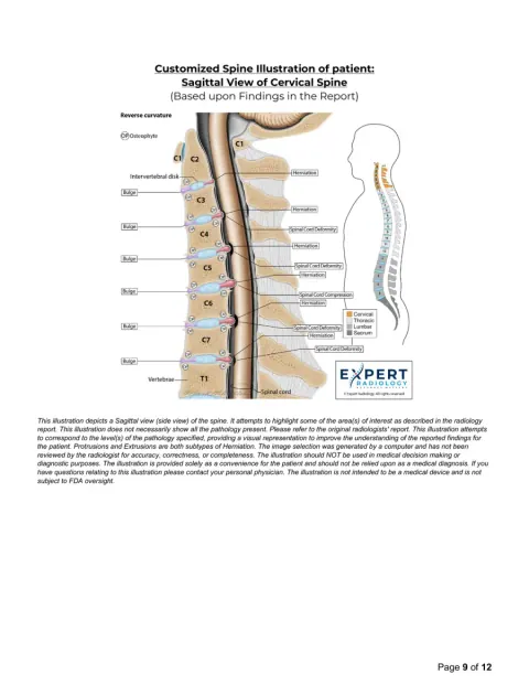 PrecisionPlus v3 report page 9 with custom sagittal spine illustration
