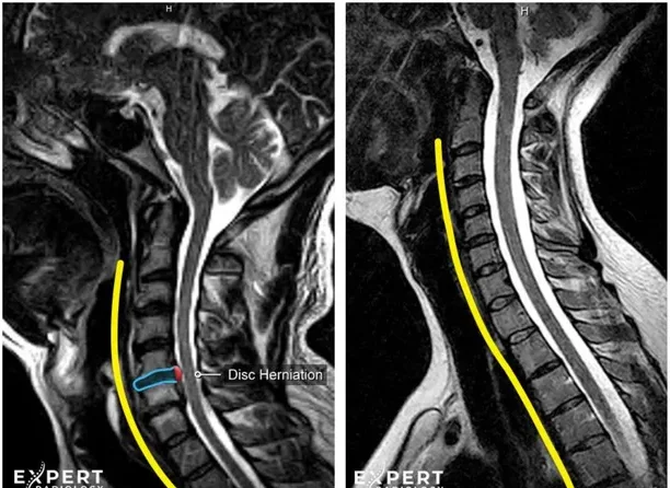 A colorized cervical spine MRI beside a normal comparison, from a PrecisionPlus v3™ sample report