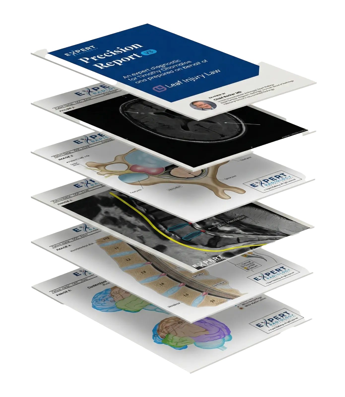 PrecisionPlus v3 stacked report pages showing various MRI visualizations and annotated medical imagery